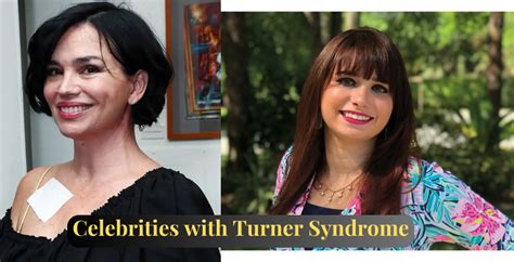 Famous People And Celebrities With Turner Syndrome Elephantsands