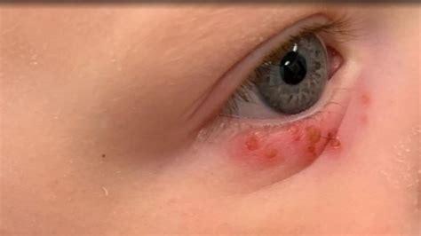 Texas Mother Discovers Blisters Around Childs Eye Is Herpes