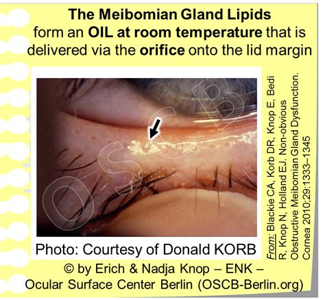 Glimpse Of The Meibomian Gland Ocular Surface Center Berlin
