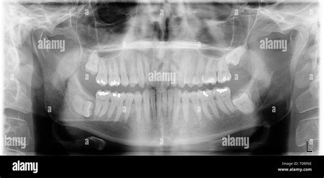 A Panoramic Xray Of A Mans Jaw And Teeth Showing His Impacted Wisdom