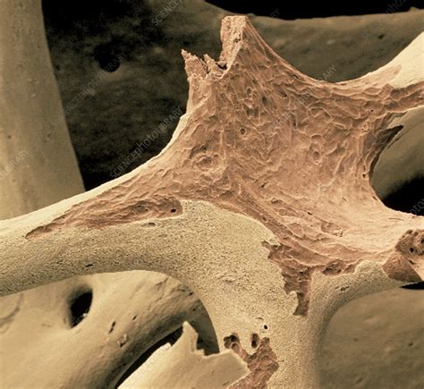 Coloured Sem Of Spongy Bone In Osteoporosis Stock Image M