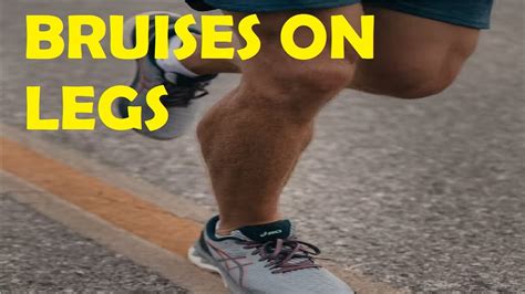 How To Get Rid Of Bruises On Legs Naturally And Quicker Youtube