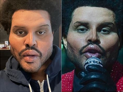 What Happened To The Weeknds Face Singer Removes Bandages To Reveal