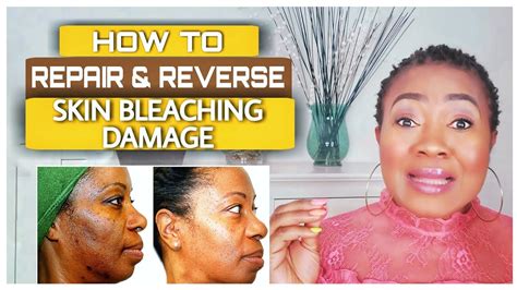 What To Do And How To Repair Skin Damaged From Skin Bleaching Youtube