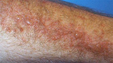 Poison Ivy Rash Pictures And Remedies