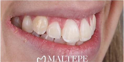buck teeth cause and treatment maltepe dental clinic