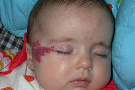 Hemangioma No Bebê Causas Sintomas E Tratamentos Vix Mobile Legends
