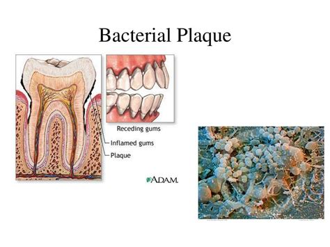 Bacterial Plaque