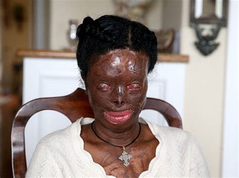 29 Year Old Mother Gets Surgery To Reconstruct Her Face After Surviving
