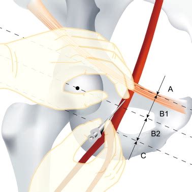 Angiographic Evaluation Of A New Technique For Common Femoral Artery