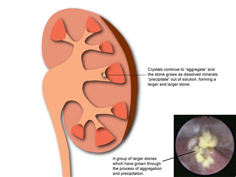 How Do Kidney Stones Form