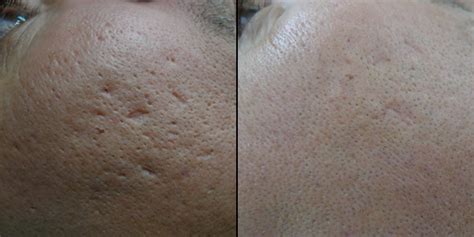 Acne Scarring Treatment London Acne Scars