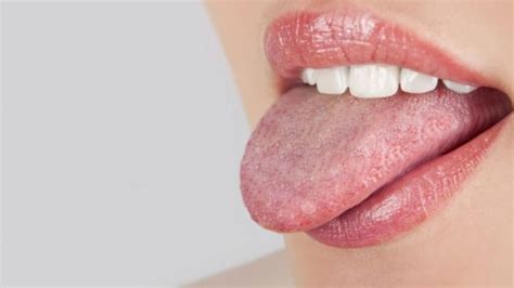 Red Spots On Tongue Under Back Tip Of Tongue American Celiac