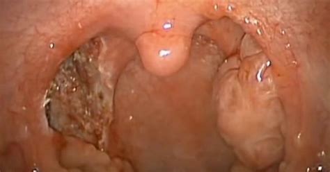 Surgeons Graphic Videos Showing Tonsils Being Taken Out Are Worldwide