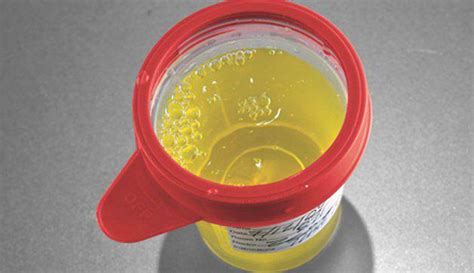 Bright Yellow Urine Colors Changes And Causes