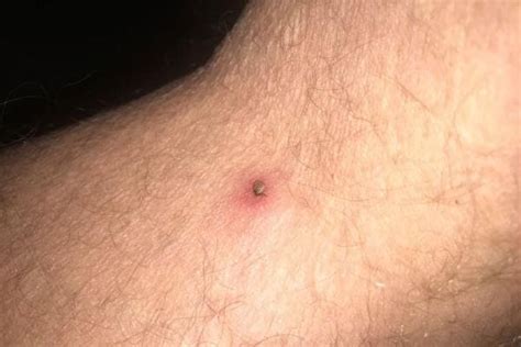 What Do Tick Bites Look Like