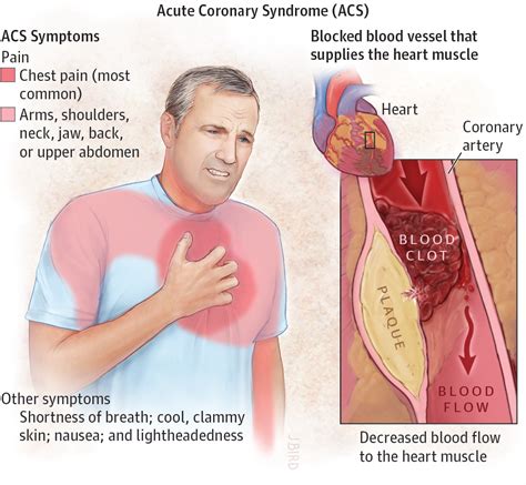 Acute Coronary Syndrome Acute Coronary Syndromes Jama Jama Network