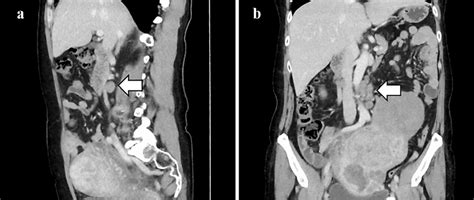 Computed Tomography Findings At The First Diagnosis Para Aortic Lymph