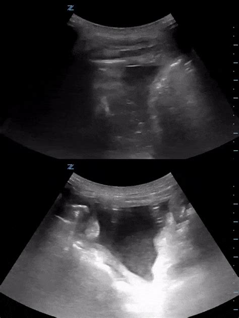 Pneumoperitoneum On Pocus Elderly M With Hypotension Grepmed