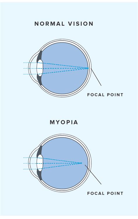 What Is Myopia Nearsightedness Warby Parker