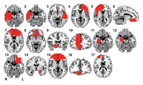 Brain Lesions Contribute To Criminal Behaviour
