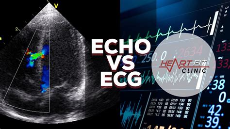 Echocardiogram Vs Electrocardiogram Youtube