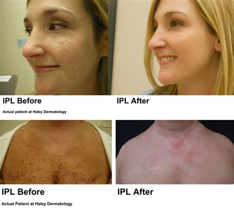 Ipl For Pigmentation Before And After