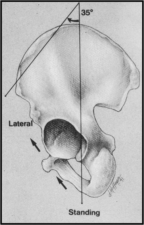 The Importance Of Acetabular Component Position In Total Hip