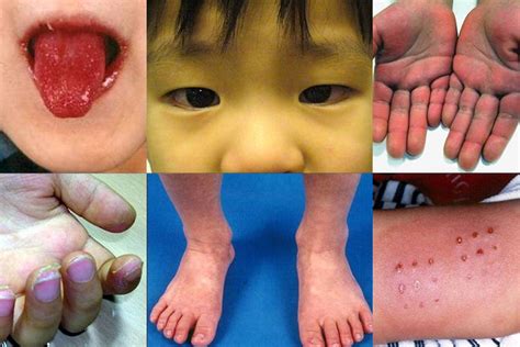Kawasaki Disease From Covid 19 In Kids How Common Medpage Today