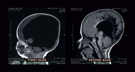 Uk Baby Noah Wall Born Without Brain Makes Incredible Progress