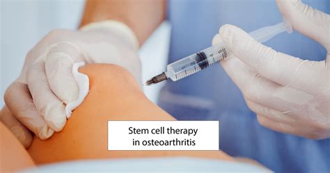 Stem Cell Therapy In Osteoarthritis What Is It Why Does It Work