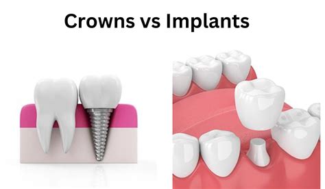 Crowns Vs Implants Which Is More Suitable Delight Dental Smiles