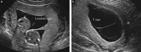 Isuog Practice Guidelines Role Of Ultrasound In Twin Pregnancy