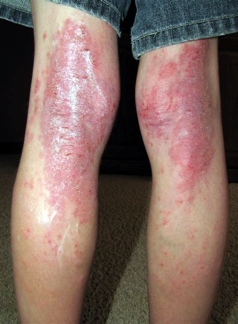 Severe Eczema 10 Year Old This Is To Document Es Skin B Flickr
