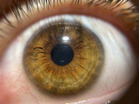 Do You Consider This As Central Heterochromia If Yes Are They Brown Or