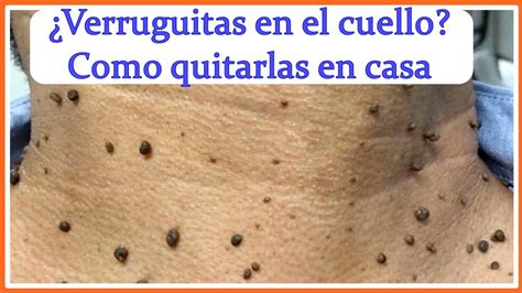 S Ntesis De Art Culos Como Quitar Verrugas En El Cuello