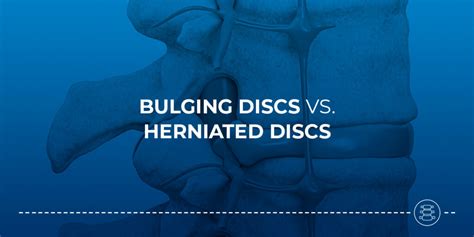 Difference Between A Bulging Disc And Herniated Disc Nysi