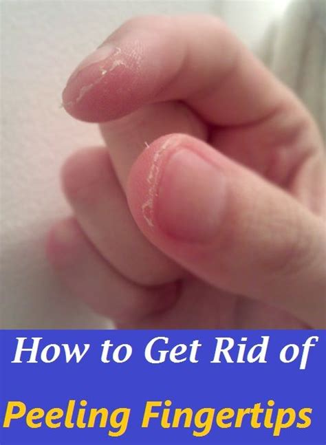 9 Home Remedies To Get Rid Of Peeling Fingertips Peeling Fingertips
