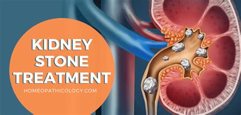Homeopathic Medicine For Kidney Stone Pain