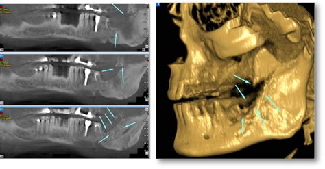 Panoramic Reconstructions And 3d Cone Beam Computed Tomography Cbct