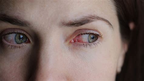 Allergic Conjunctivitis Causes Symptoms And Treatment Allergy And Immunology Center