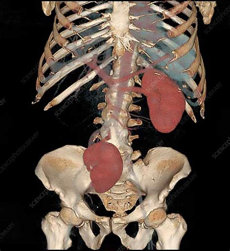 Ectopic Kidney Ct Scan Stock Image C0353639 Science Photo Library
