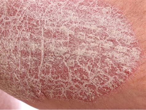 Psoriasistype Causes Symptoms And Treatments