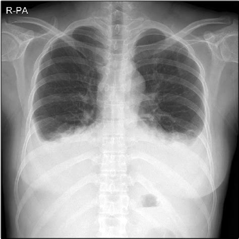 Chest X Ray In May Revealed Bilateral Pleural Effusion Treated Sexiezpix Web Porn