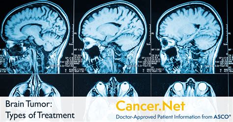 Chemo For Brain Cancer Stage 4 Cancerwalls