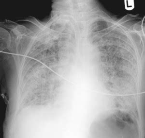It can either result from a direct pulmonary source or as a response to systemic injury. There is a new definition of ARDS. :British Columbia ...