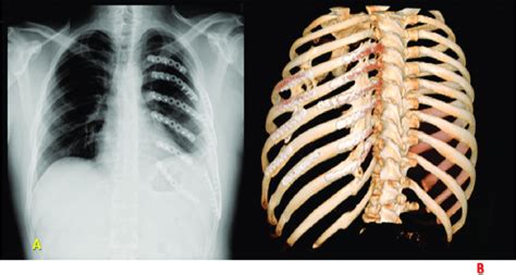 A An Ap View Of Chest X Ray Six Months Postoperation The Rib Cage