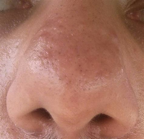 Skin Concerns Raised Bumps From Old Acne That Just Wont Go Away