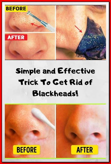 Simple And Effective Trick To Get Rid Of Blackheads Healthy Lifestyle