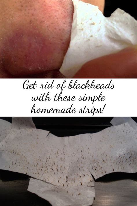 The gentle exfoliant will help to remove the blackheads on your back. Get rid of blackheads with these simple homemade strips ...